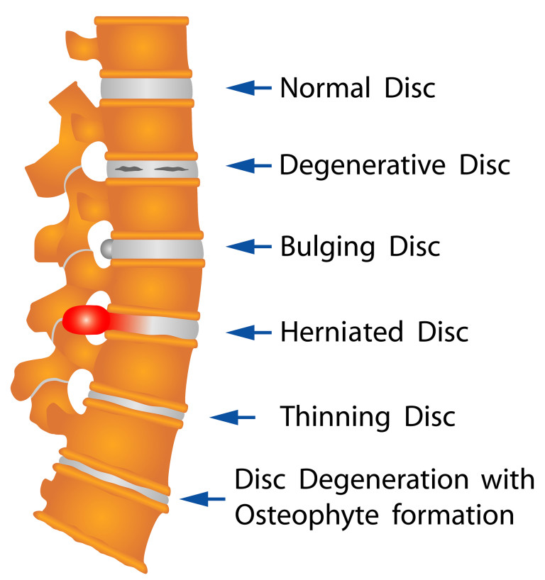 Treat A Herniated Disk With Chiropractic Care Cafe Of Life