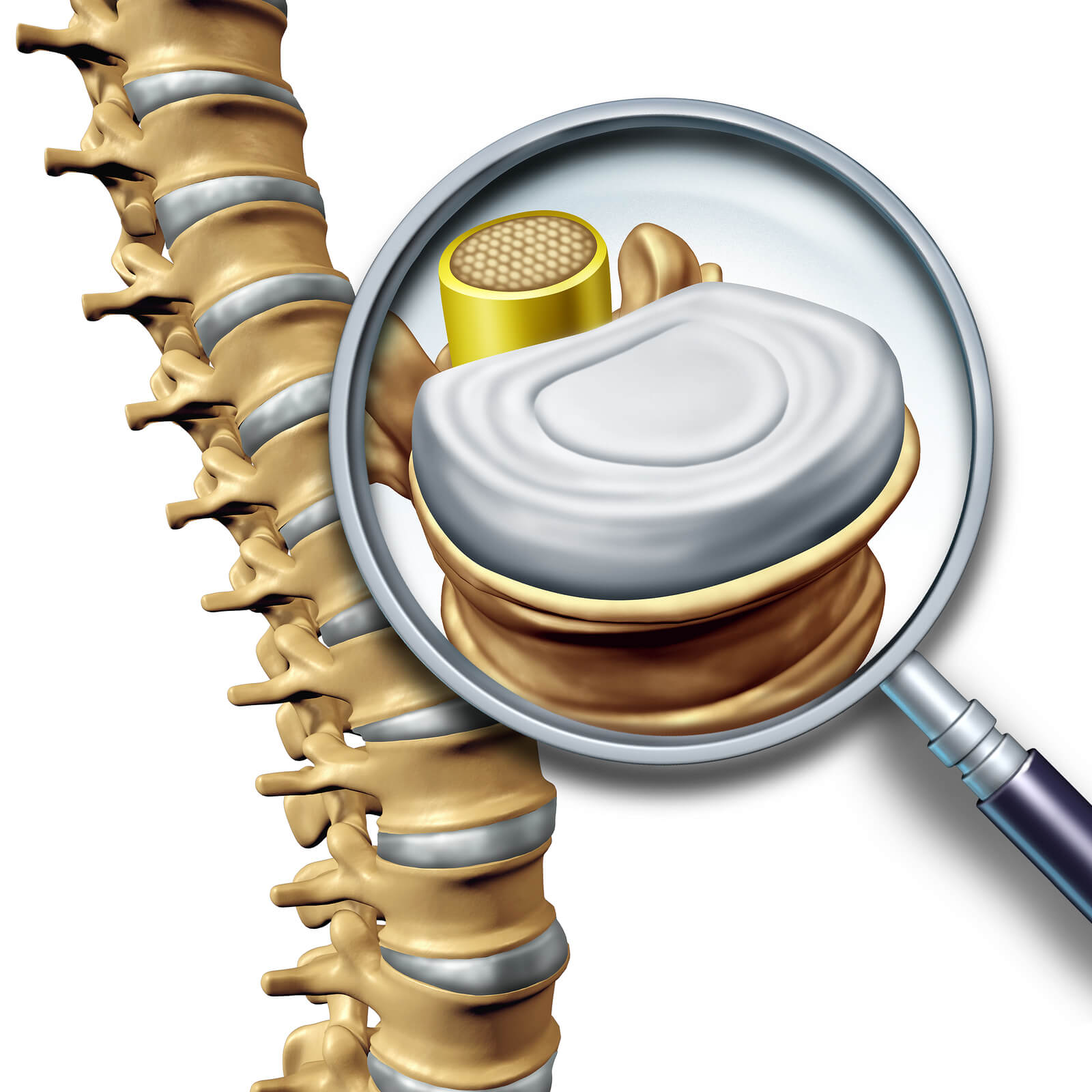 What Does Spinal Traction Do