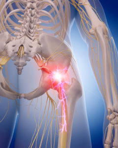 Sciatica Pain Relief With Massage And Chiropractic Treatment